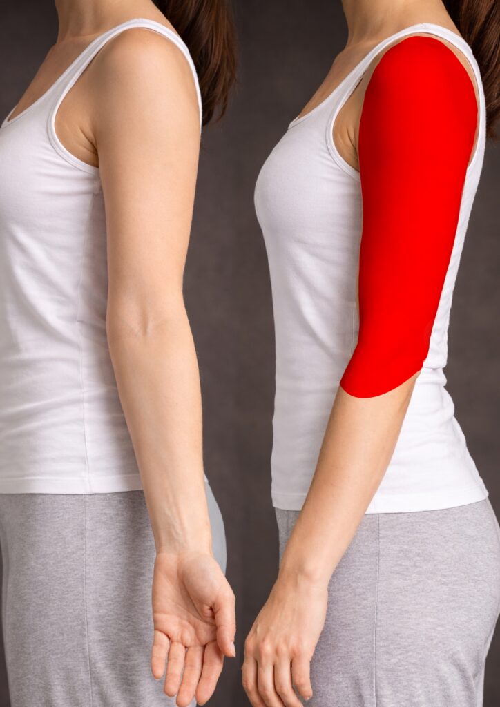 Arm — shoulder to elbow, one side